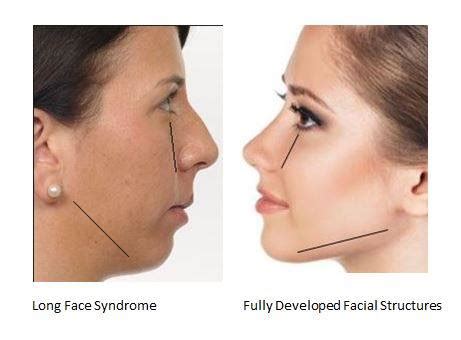 Long Face Syndrome