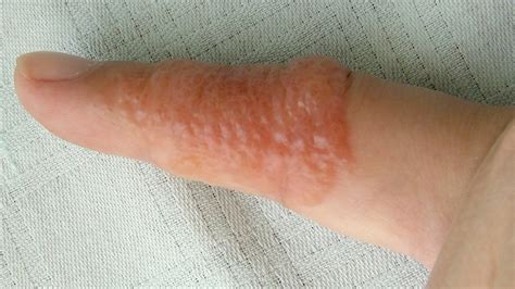 Clear Bumps On Skin