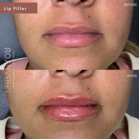 dermal fillers  grand rapids northville facial fillers urban