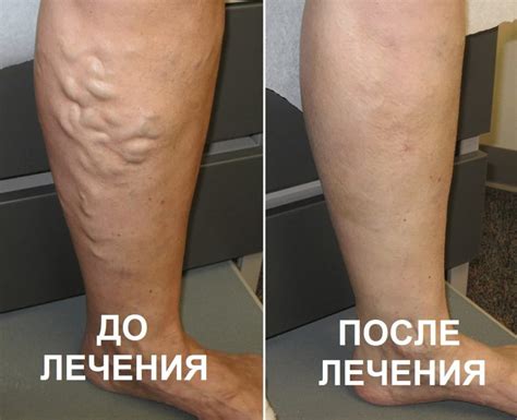 Начало варикоза фото