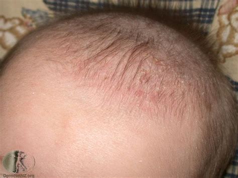 Seborrheic Dermatitis in Children - Tendig