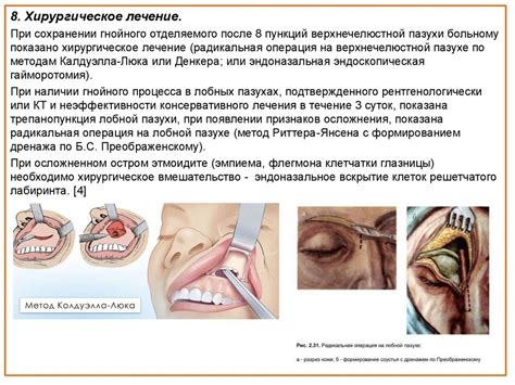 Острые синуситы - презентация онлайн