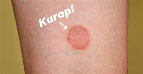 jangan kongsi tuala  stoking  elak kurap akibat jangkitan kulat