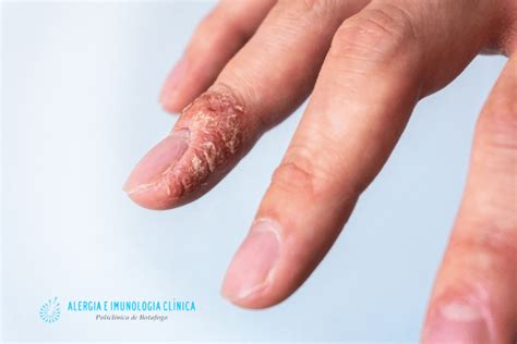 Alergia A Unha De Gel - Alergia a esmalte de unha. - Alergia Botafogo - Alergistas Rio de Janeiro