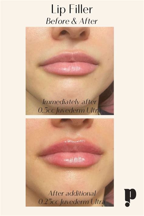 Before and After Lip Filler .75 cc of Juvederm Ultra | Lip fillers, Lip ...