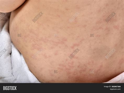 Roseola Rash Viral Image & Photo (Free Trial) | Bigstock