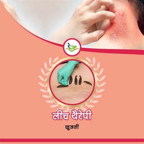 Leech Therapy – Narmade Ayurvedam