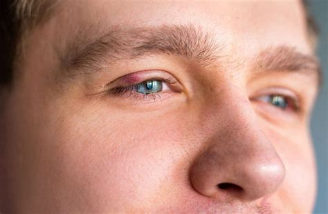 Chalazion vs. Stye: What’s the Difference & Treatment Options ...