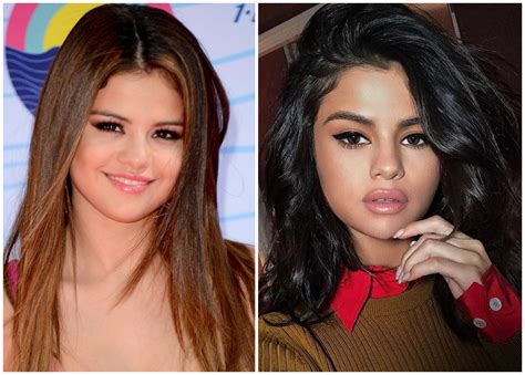 Did Selena Gomez Get Lip Injections? See the Pics!