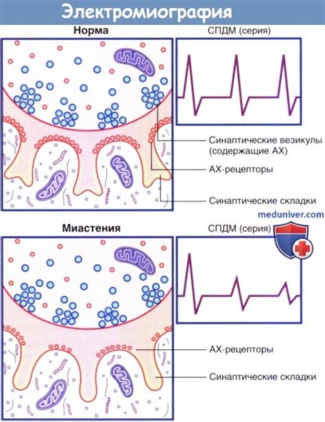 Методика электромиографии (ЭМГ). Электромиограмма в норме
