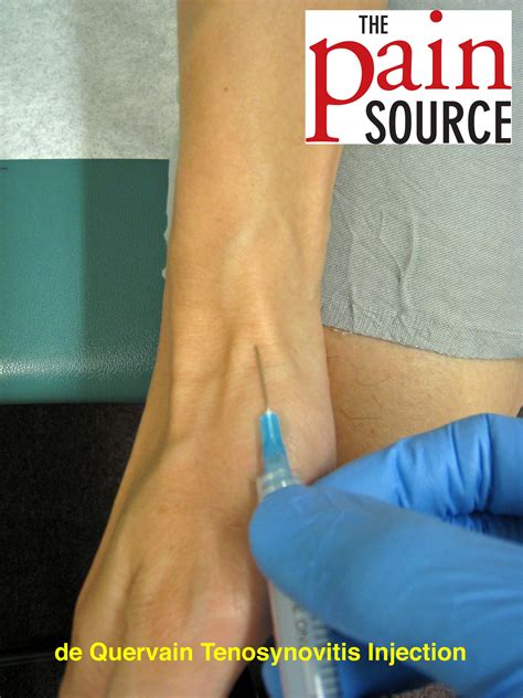 De Quervain’s Tenosynovitis Injection – Technique and Tips - The Pain