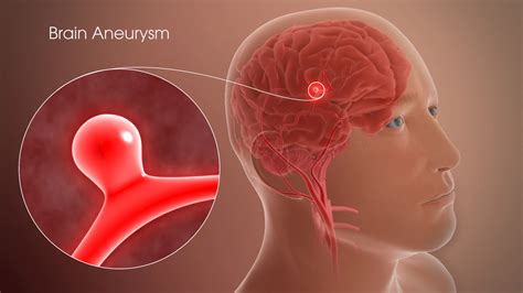 Brain Aneurysm Repair – Dr.Samir Parekh