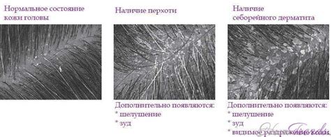 Чем лечить себорейный дерматит на голове