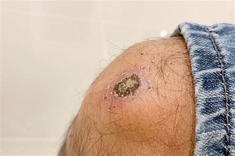 scraped knee sepsis  david meza blog