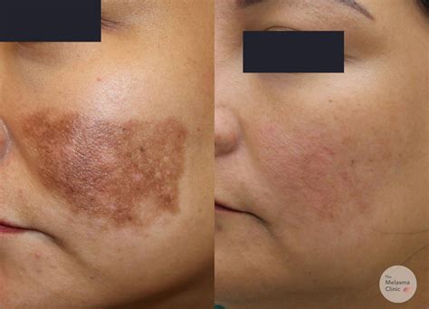 post inflammatory hyperpigmentation  melasma clinic