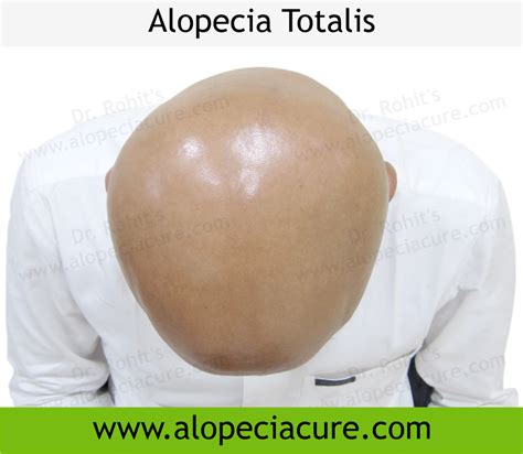 Alopecia areata - Treatment, Types, Causes