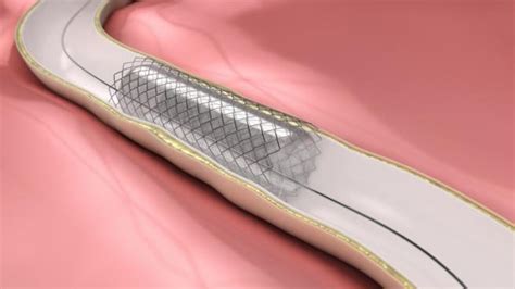 Stent : actif ou nu, comme se déroule la pose d'un stent