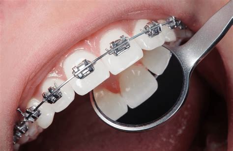 Z Dental Studio - Dental braces In Islamabad - Teeth braces