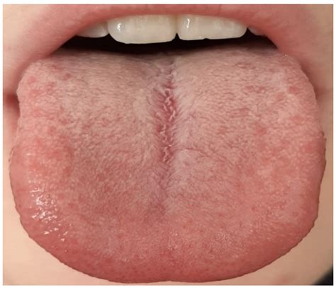 Hygiene | Free Full-Text | Microbiota of the Tongue and Systemic ...