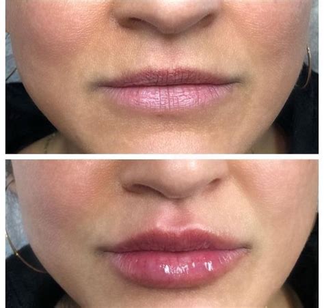 Коррекция губ | Produit de maquillage, Chirurgie plastique, Maquillage ...