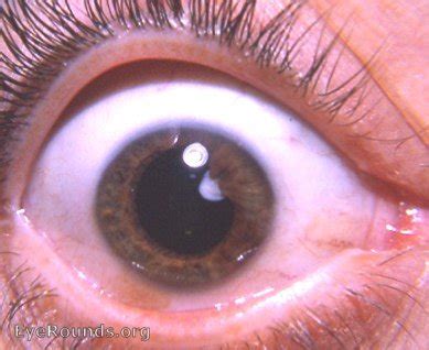 Persistent pupillary membrane with anterior cataract. EyeRounds.org ...