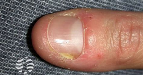 Candida albicans affecting the nails image