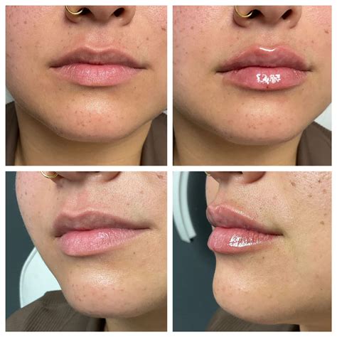 expect   lip filler appointment moderna laser