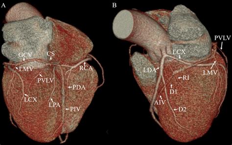 Coronary Artery Anatomy Ramus