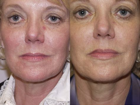 Before & After Pictures | Lip Augmentation & Injection Chicago, IL |Dr ...
