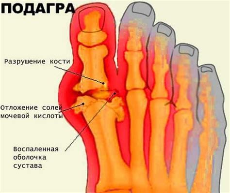 Как лечить подагру с помощью медикаментов и народных средств