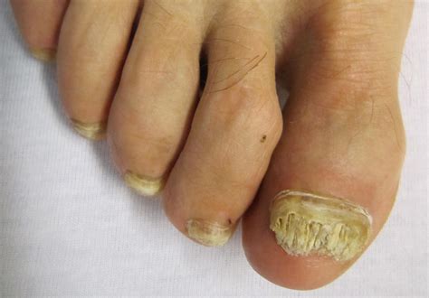 Mayo Clinic Toenail Fungus at Lori Mercado blog