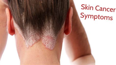 Identify Skin Cancer Symptoms at Very First Stage