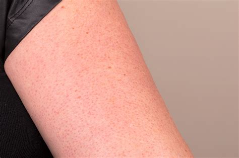 How to Treat Keratosis Pilaris (Those Scaly Red Bumps On Your Upper ...