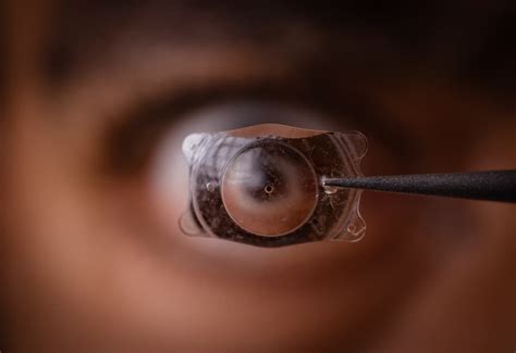 implantable collamer lens  lasik