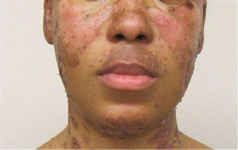 Acute cutaneous lupus erythematosus (ACLE) | Download Scientific Diagram