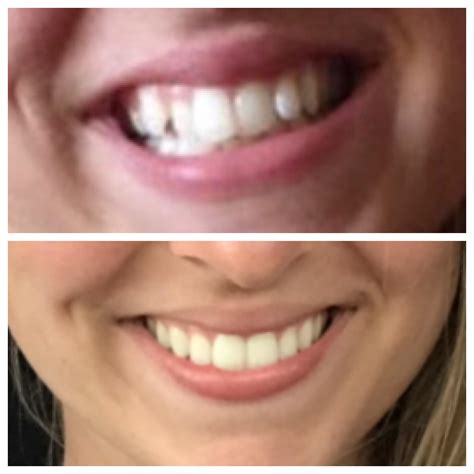 Transform Your Smile: Invisalign Before and After Photos Showcase Dramatic Transformations 1
