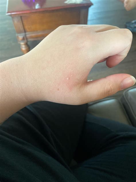 kind  bite   rbugbite