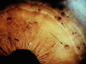 Neurofibromatosis Type 1 Lisch Nodules