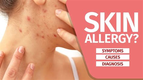 Skin Allergy In Genital Area | Genital Eczema Signs, Causes, and