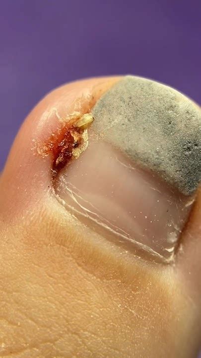 Течёт и ПУЗЫРИТСЯ!😱Что с Ногтем?педикюр ПЕРЕВОПЛОЩЕНИЕ.ДО/После #nails ...