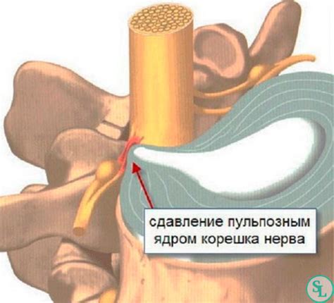 Корешковый синдром позвоночника - причины и лечение., поясничного и ...
