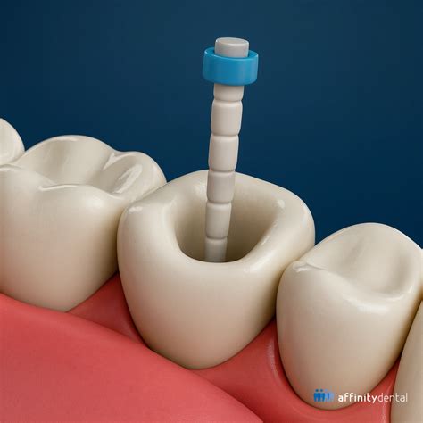 post  core philippines tooth support  restoration  rct