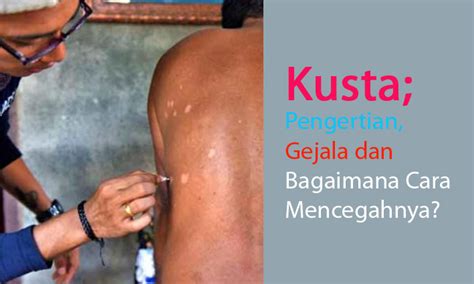 kusta pengertian gejala  bagaimana  mencegahnya kopiah putih