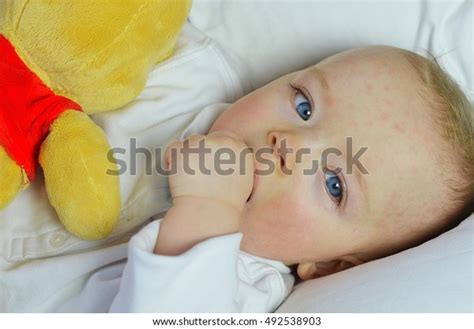 baby boy suffering sixth disease threedayfever stock photo