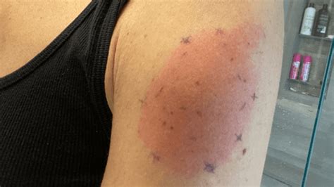 "COVID Arm": We Asked A Doctor About The Unusual But Harmless Delayed ...