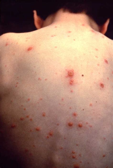Diagnosis Varicella - Alomedika