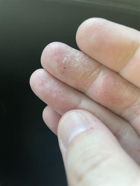 Dry Skin On Just One Finger at Mario Harrell blog