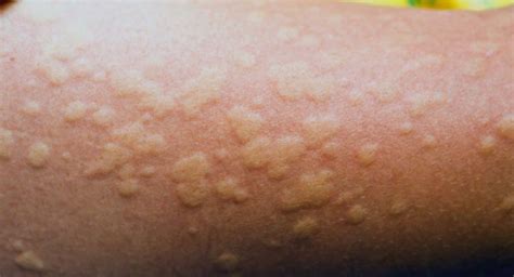 urticaria  overview dr walias skin  laser clinic