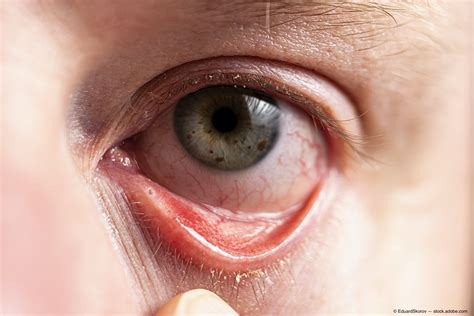 Understanding The Three Kinds Of Conjunctivitis Cause - vrogue.co