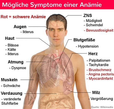 Anämie Normochrom Normozytär 1